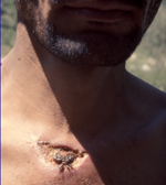 Man with an open chest wound